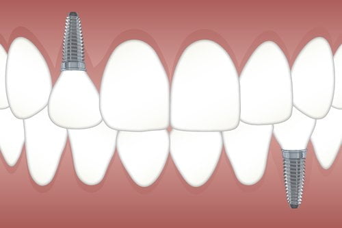 Who Is An Ideal Candidate For A Dental Implant?