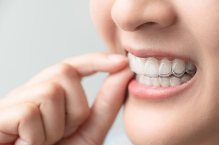 10 Tips for Wearing Clear Aligners from Our Dentists