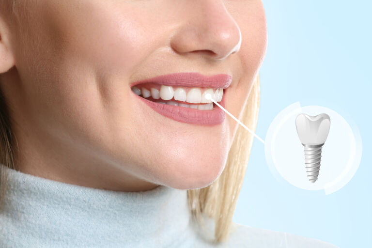 Why Choose Dental Implants to Replace Teeth?