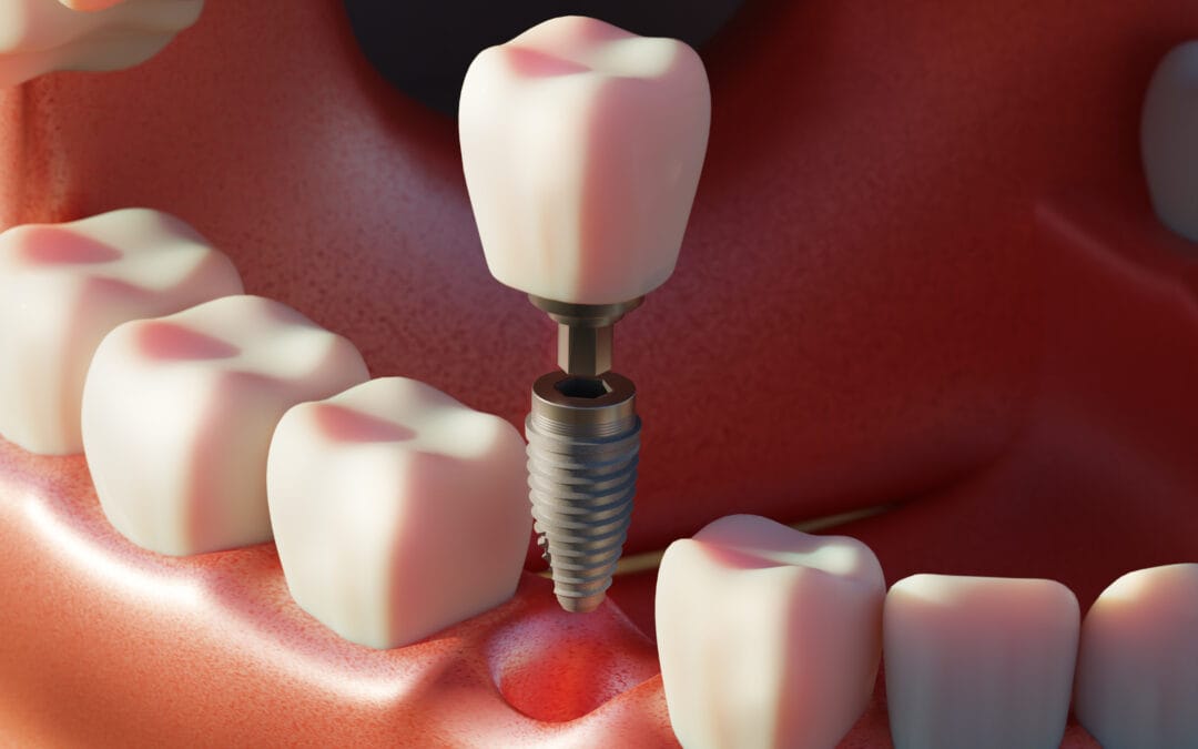 Bone Grafting for Dental Implants: When Is It Necessary?