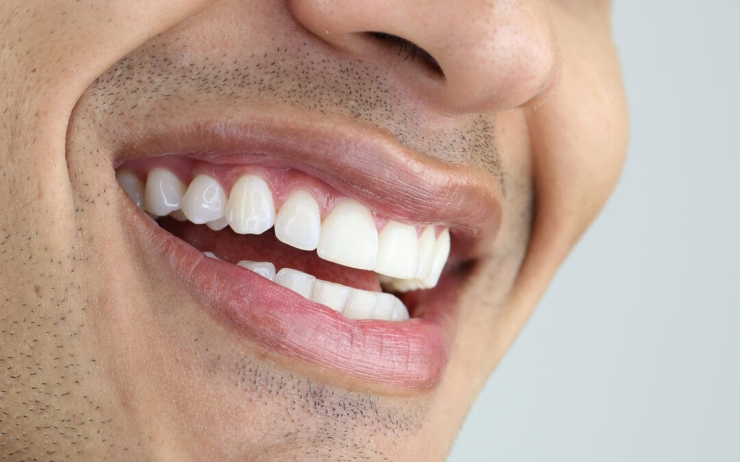 Does Teeth Whitening Damage Your Enamel? Myths vs. Facts