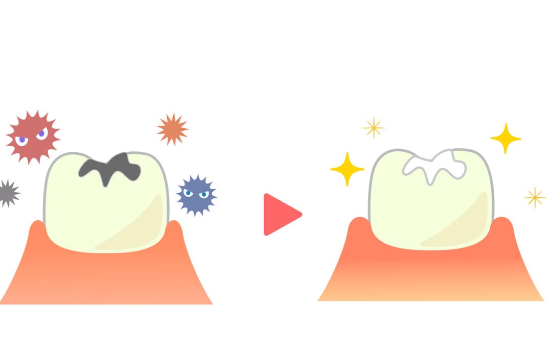 How Sealants Help Protect Children’s Teeth?