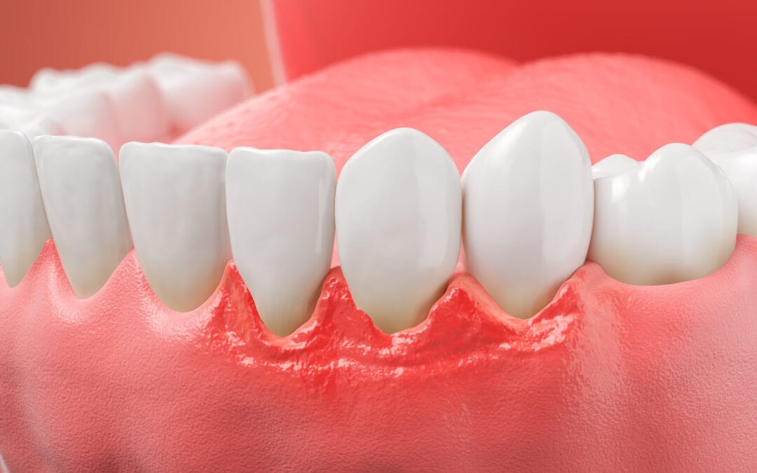 Preventing Gum Disease in Adults