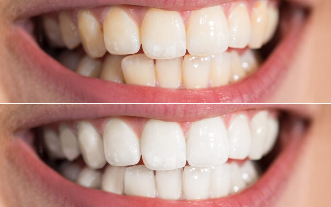 Teeth Whitening: How Long Does It Last and Is It Safe?